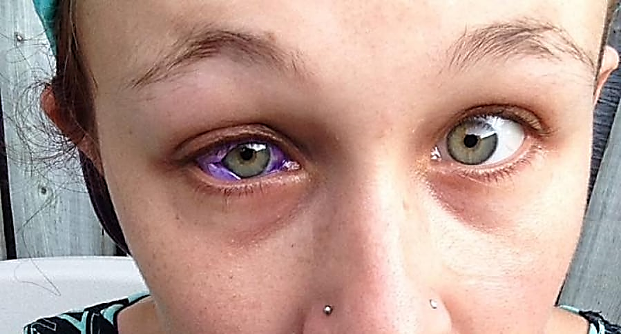 Cat Gallinger sufre un problema con su tatuaje en los ojos
